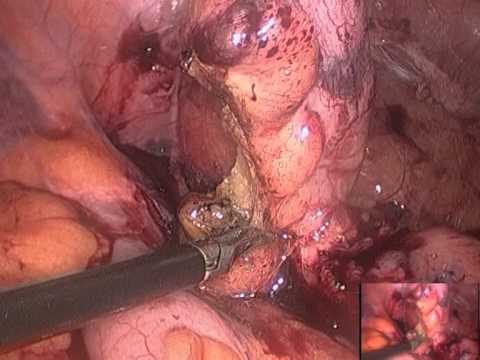 Laparoscopic Appendectomy -difficult  Case By  Dr Riadh Alani