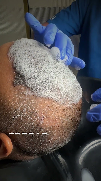 1st Head Wash After 10 Days of Hair Transplant | Post Care
