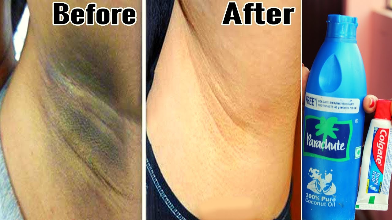ಕಪ್ಪಾದ ಅಂಡರ್ ಆರ್ಮ್ಸ್ ಬಿಳಿಯಾಗಲು ಮನೆಮದ್ದು । underarms whitening home remedy