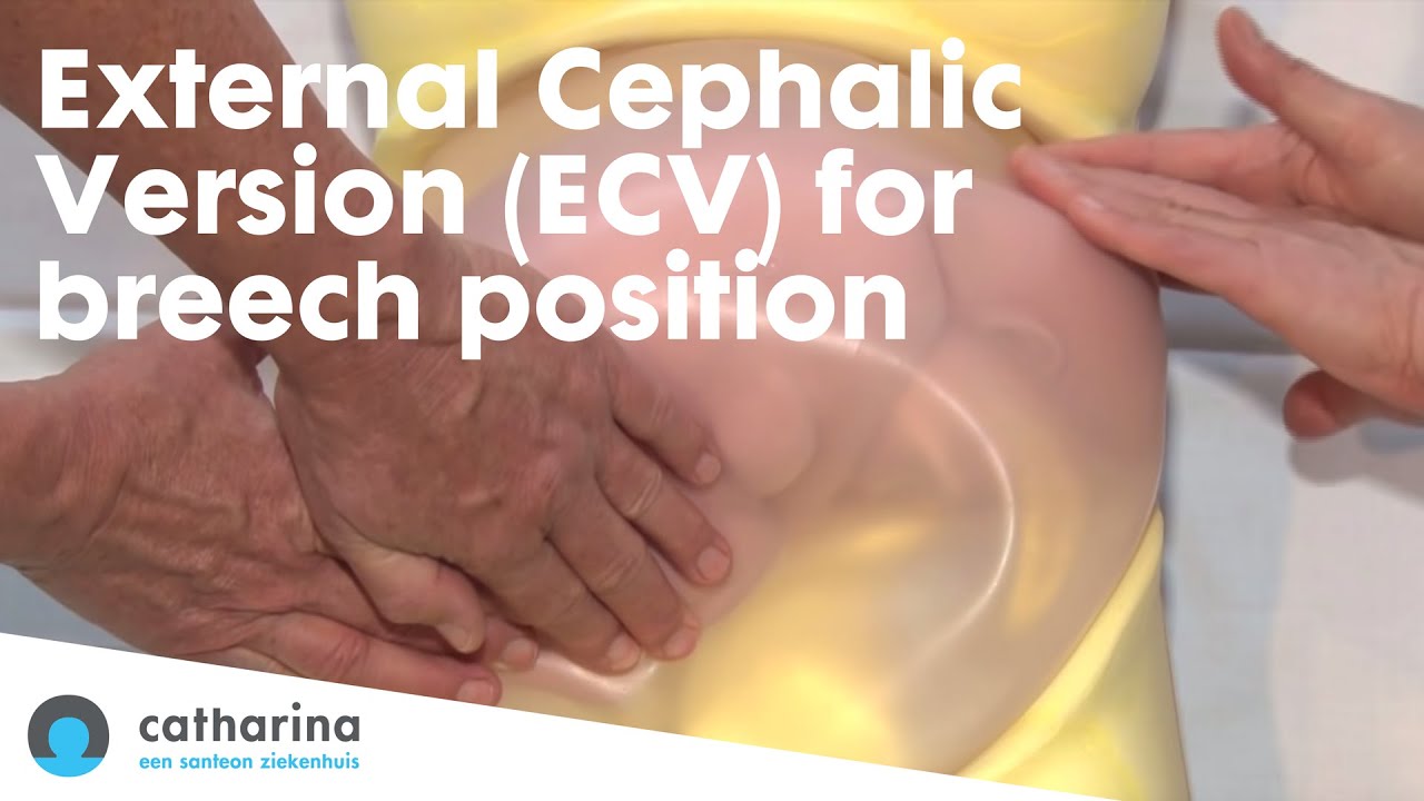 External Cephalic Version Ecv For Breech Position At Catharina Hospital The Netherlands Youtube