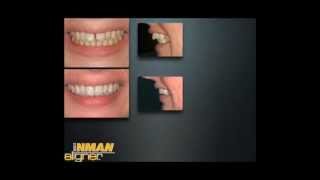 Inman Aligner Dentist Sydney- Castle hill NSW www.dentistcastlehill.com 02 9659 1200