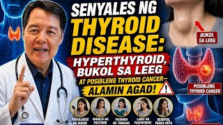 Senyales ng Thyroid Disease: Hyperthyroid, Bukol sa Leeg at Posibleng Thyroid Cancer—Alamin Agad! @DocWillieOng