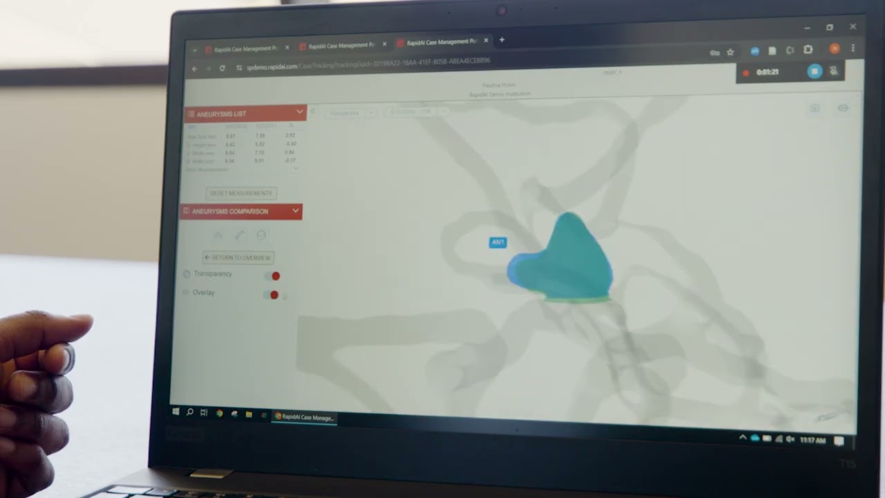 RapidAI | Rapid Aneurysm Demo