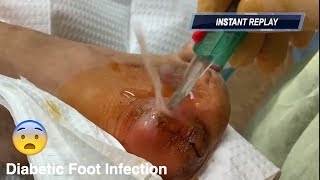 diabetic foot infection v2