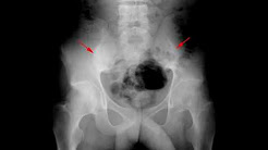 Ankylosisng spondylitis