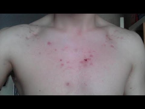 how to get rid of pimples on chest and back fast