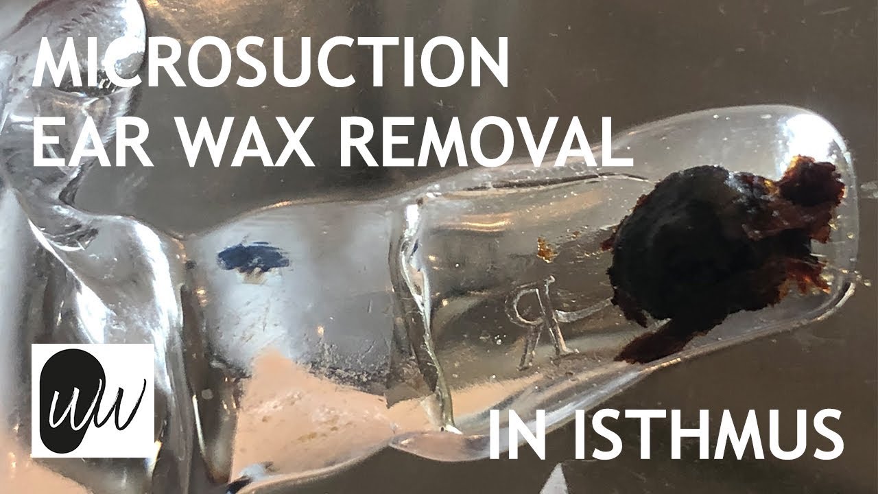 Microsuction Ear Wax Removal of Ear Wax Stuck in Isthmus of Ear Canal