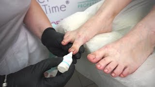 Вросший ноготь. Поэтапная процедура удаления ногтя и рекомендации. - Видео от domixpro