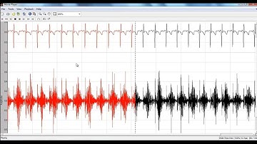 Phonocardiogram Signals Matlab Projects | Phonocardiogram Signals Matlab Thesis