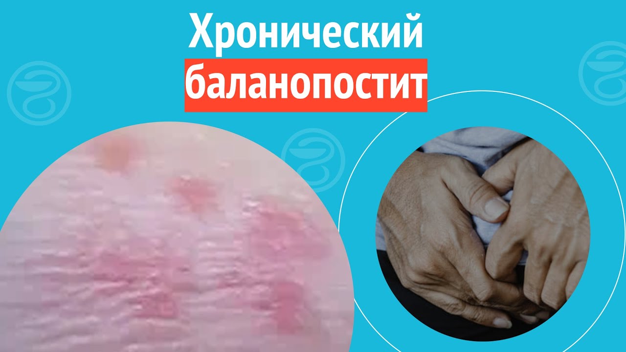 ️ Хронический баланопостит. Клинический случай №1313 - YouTube