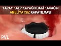 PVL KAPATMA | Paravalvüler Kaçak Nasıl Kapatılır?