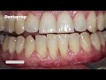 Contention parodontale dentapreg