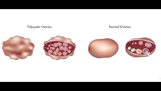 Polycystic Ovary Syndrome (PCOS)