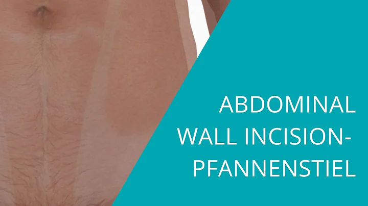 Abdominal Wall Incision - Pfannenstiel - How to ap...