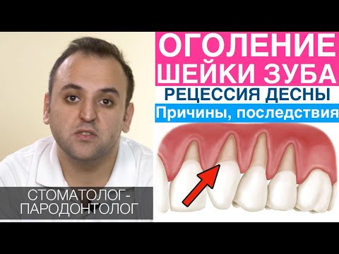 Оголение шейки зубов (рецессия десны) - причины и последствия рецессии десны