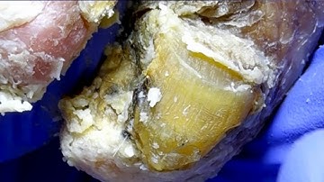 The Toenails Are Gradually Covered With Fungus And Are Slowly Removed【Dr. Liu
