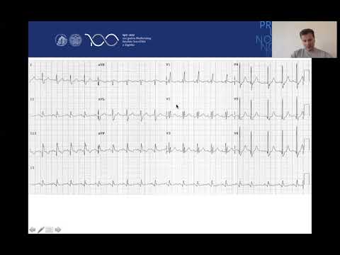 EKG  Ventrikulska tahikardija