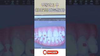 임플란트 후 치아교정 가능할까?#임플란트 #shorts #치아교정