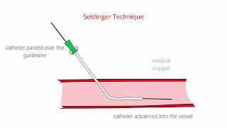 Seldinger Technique & Modified Seldinger Technique