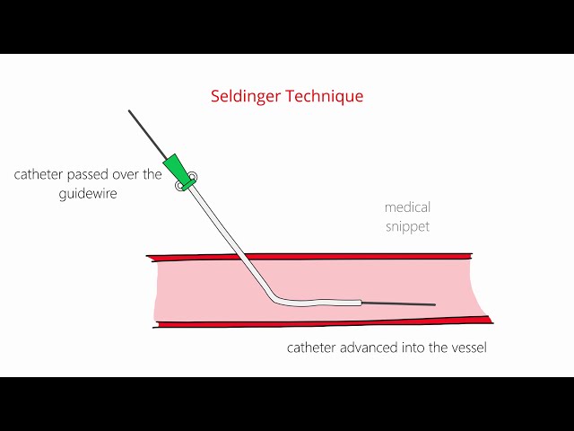 Seldinger Technique & Modified Seldinger Technique class=