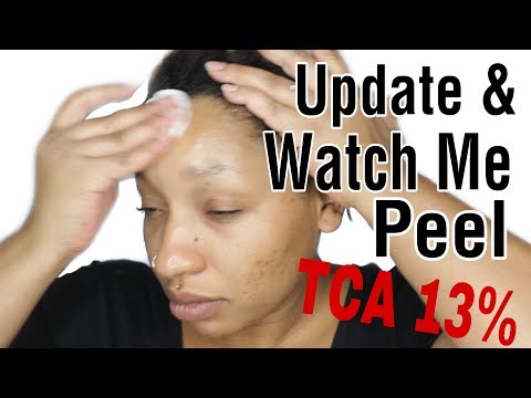 UPDATE + 2 LAYERS 13% TCA |PREP, PEEL, AFTERCARE DIY CHEMICAL PEEL AT HOME | Ebony White