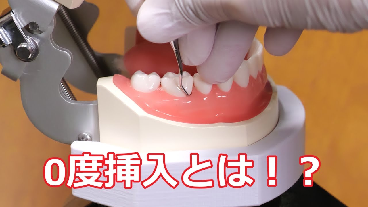 分かりやすい！SRP時の0度挿入【予防処置】