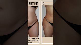 Brazilian Butt Lift Surgery | BBL | Body Contouring | Hour Glass Shape