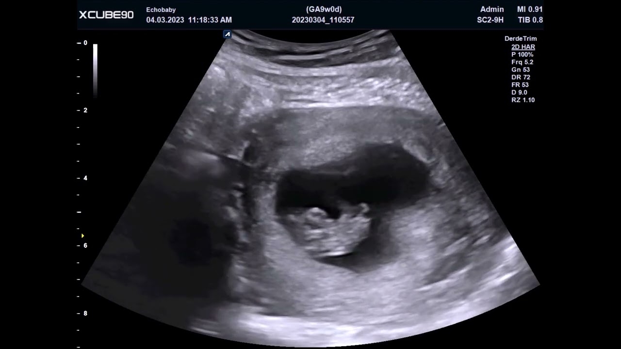 9 Weken Zwanger, 2D Pretecho, Filmpjes