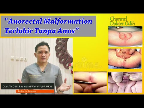 anorectal Malformation Terlahir Tanpa Anus