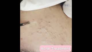 Comedone Extraction (Acne Treatment)
