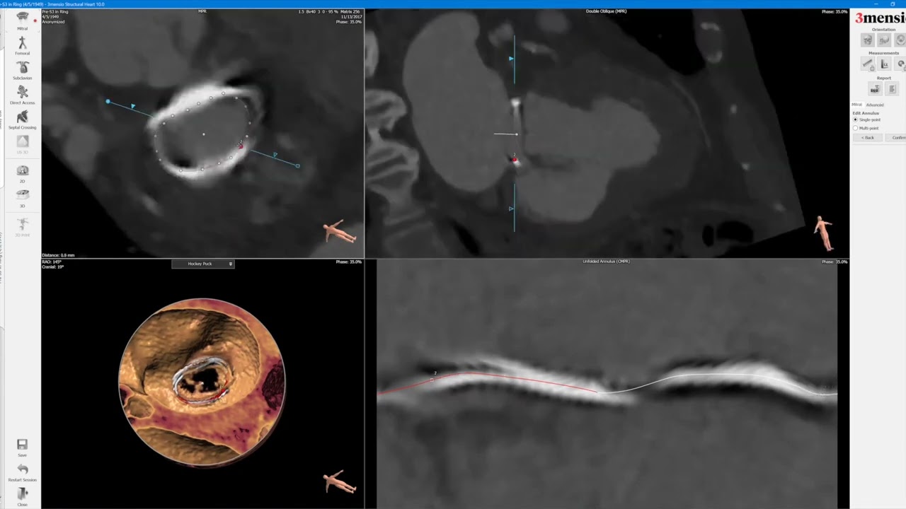 Twelve-month outcomes of the LuX-Valve for transcatheter treatment of  severe tricuspid regurgitation | EuroIntervention