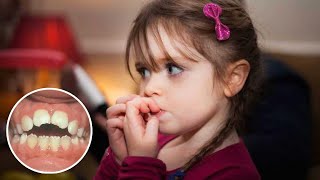 Cuidado: Si tus hijos se muerden las uñas, mira este video