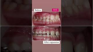MSE before and after #mse #orthodontics #marpe #expansion #airway #breathing #expander