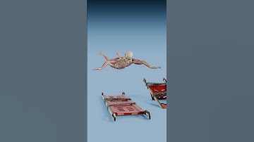 One Broken Bone vs 64 Broken Bones