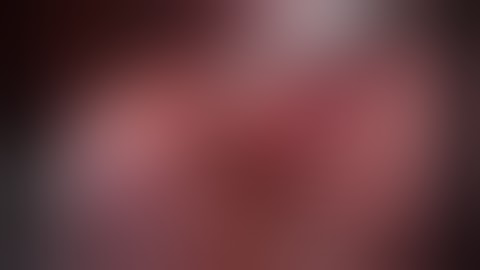 Right Laparoscopic Pyeloplasty by Dr Shyam Varma