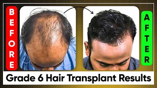 Norwood Grade 6 Hair Transplant in Men | Hair Transplant Month by