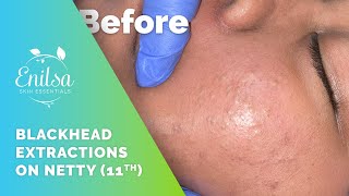 Blackhead Extractions on Netty - 11th Treatment