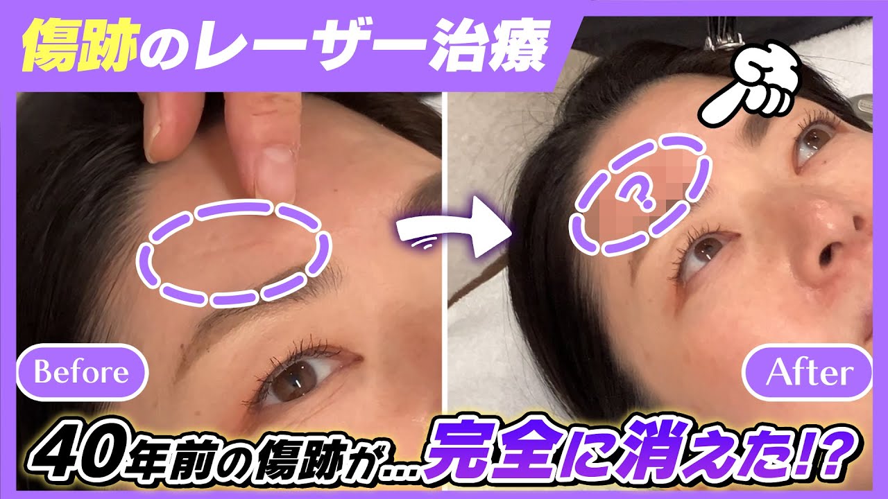 【顔傷の治し方】40年前の傷跡をフラクショナルレーザーで治療！レーザー治療 完全密着！【肌治療】