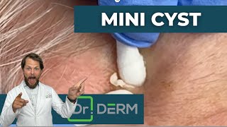 Mini Cyst | Dr. Derm
