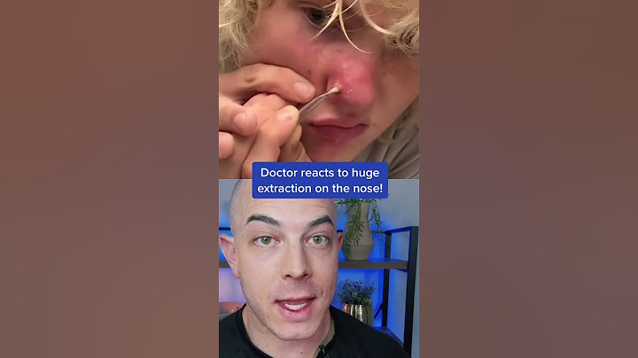 Doctor reacts to massive nose pimple extraction! #nosepimple #pimplepopper #dermreacts