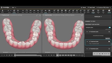 Finishing Invisalign Treatment but with Limited Refinement