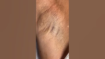 UnderArm Wax Near Me #ingrownhair #ingrownhairremoval #treatments #waxing #underarmswaxing