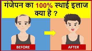 गंजेपन का 100% स्थायी इलाज क्या है? What is the ultimate solution for baldness?