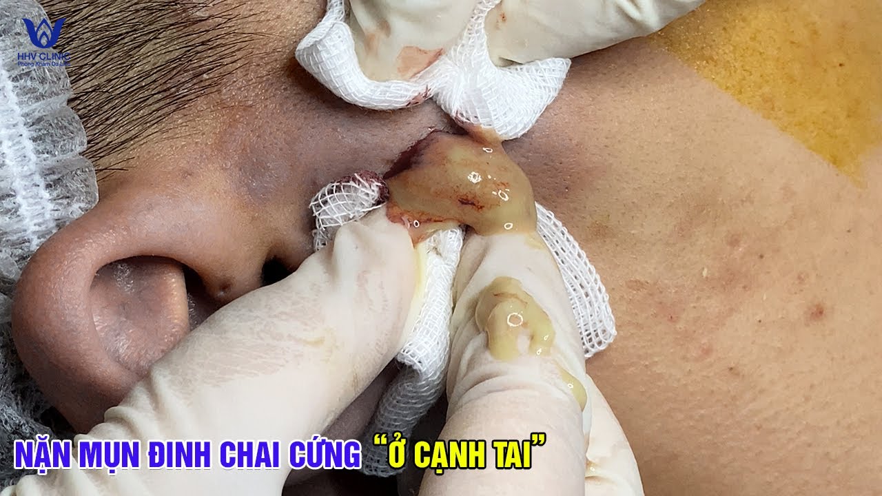 Trường hợp nặn mụn đinh ở cạnh tai – Bác sĩ xử lý nhẹ tay, sạch mủ.