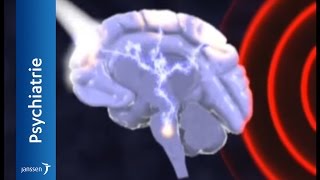 Migräne: Was passiert im Gehirn?