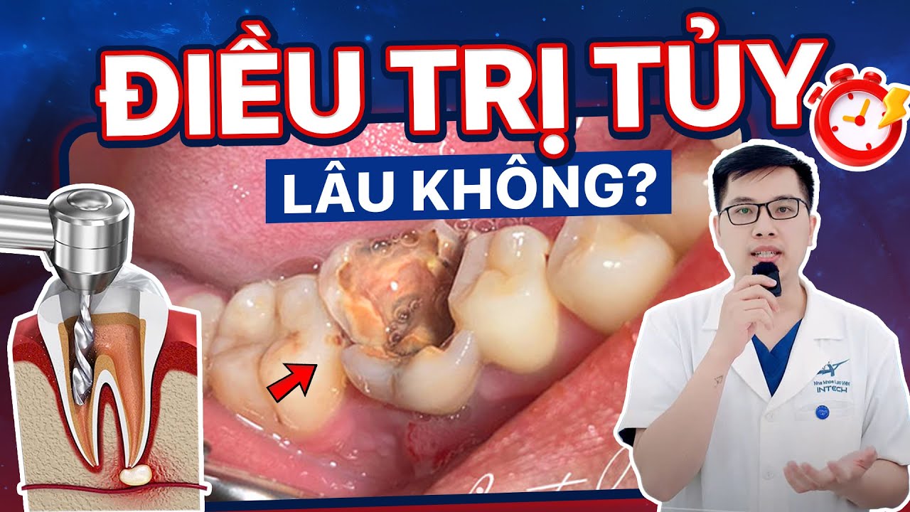 Outline Video Điều Trị Tủy Răng Mất Bao Lâu? Cần Bao Nhiêu Lần Hẹn? Tại Sao Thời Gian Điều Trị Mỗi Người Khác Nhau