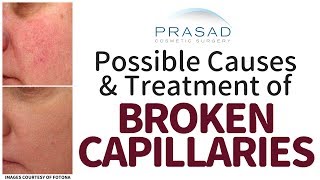 Potential Causes of Broken Capillaries on the Face, and How They can be Treated with Lasers