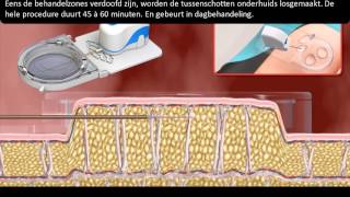 Celluliteverwijderen Permanent Perfection Insuut Brussel - België