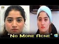Watch How To Get Rid Of Acne - Treatment By Shaista Lodhi Online In Hd