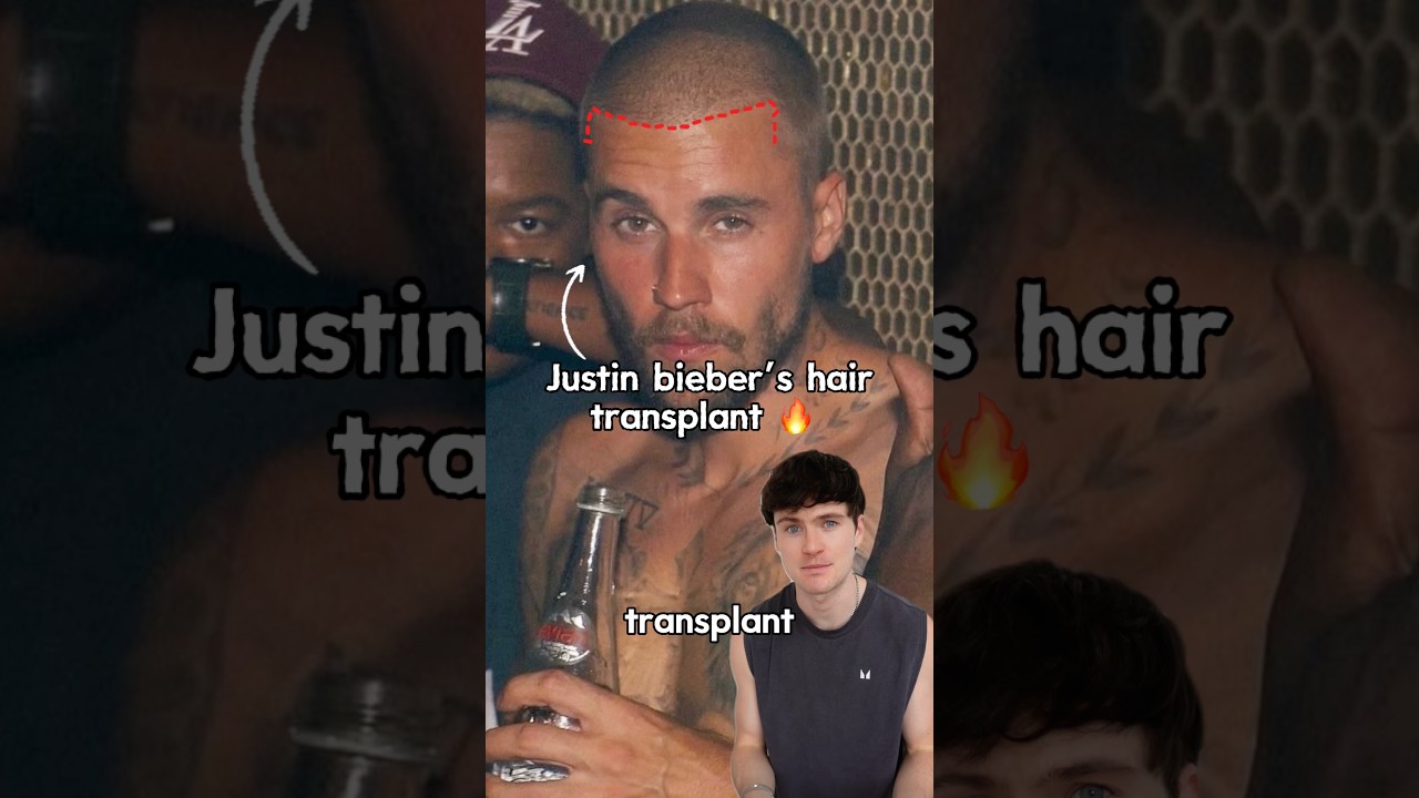 Justin Bieber’s hair transplant 🔥